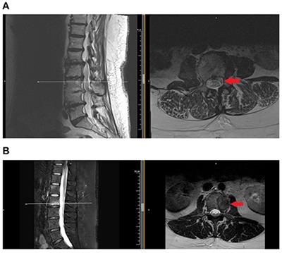 Interventional and Non-interventional Medical Rehabilitation Approaches to Axial Spine Pain in Vertebral Metastatic Disease